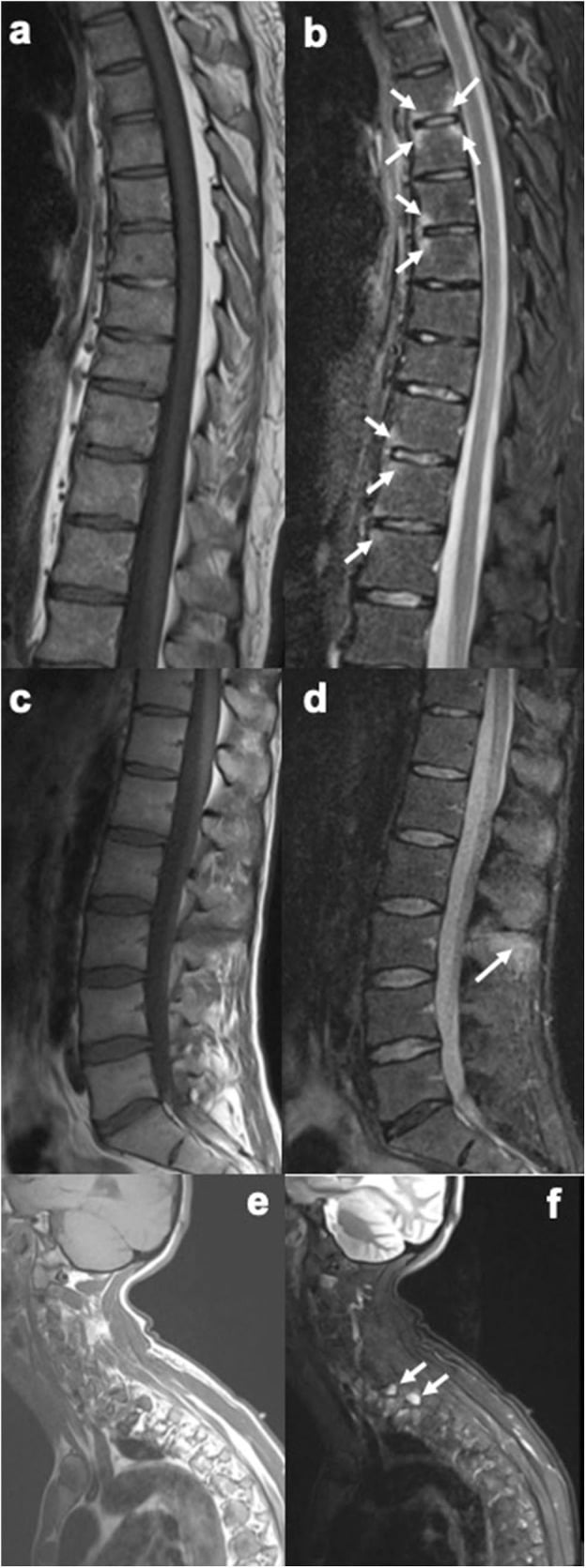 Paired T1 and STIR MRI showing anterior and posterior vertebral corner inflammation and spinal enthesitis