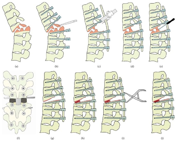 Stepwise operative diagrams of transpseudarthrosis osteotomy, decompression, interbody fusion and posterior fixation