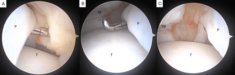 Three arthroscopic views (A to C) of an ankle plica (P) over the talus (T), with a probe beneath the plica in A and B