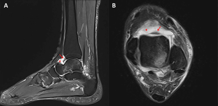 Two-panel ankle MRI (A and B) with an arrow marking a low-signal band in the anterior recess and an asterisk marking the adjacent high-signal fluid