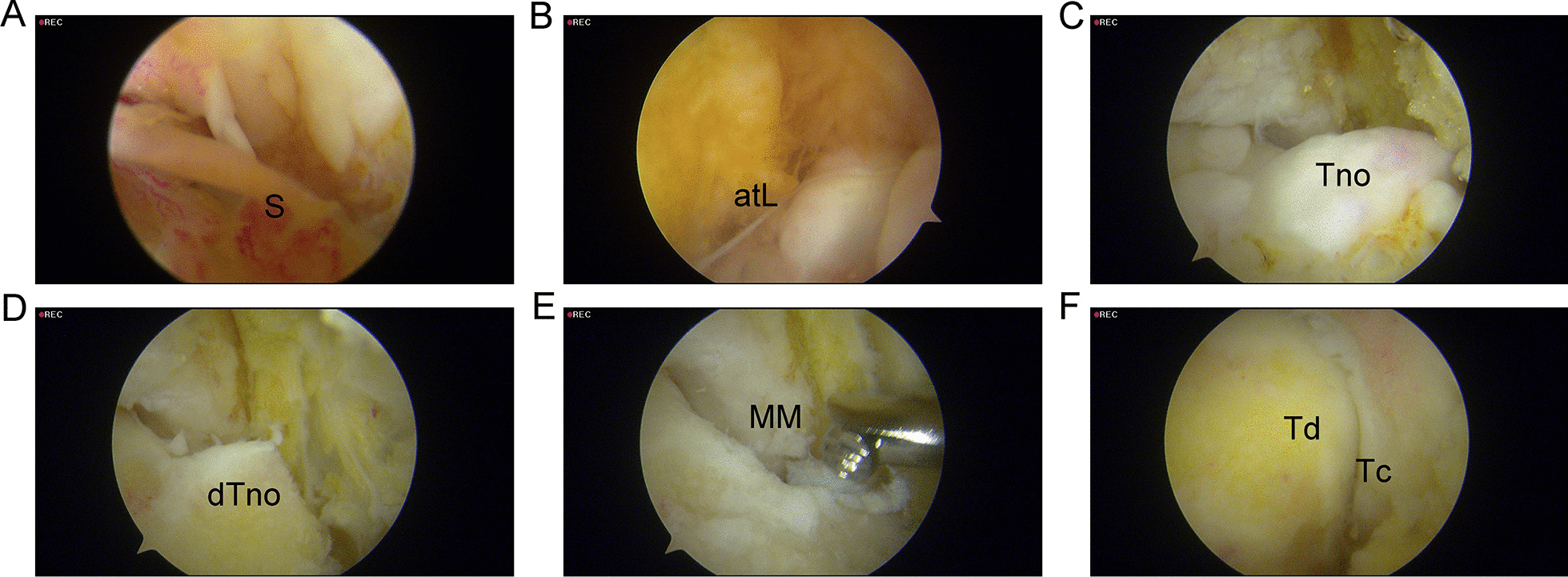 Six-panel arthroscopic sequence (A to F) of an anteromedial ankle osteophyte resection, with a burr in use in panel E