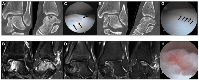 CT, MRI and arthroscopic images (A to H) following a chronic osteochondral talar lesion