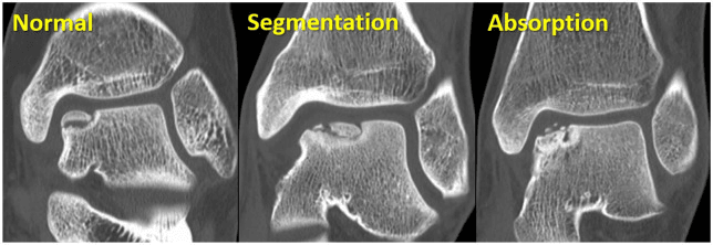 Coronal CT of three osteochondral talar lesions labelled normal, segmentation and absorption