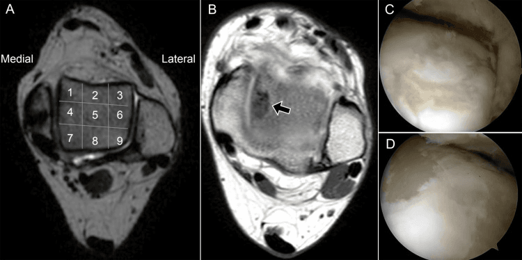 Axial MRI of the talar dome with a nine-zone grid labelled medial and lateral, a second MRI with an arrow at a medial talar dome lesion, and two arthroscopic views of the talar dome