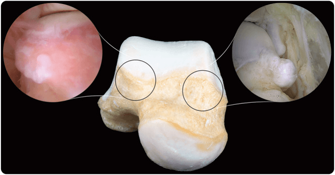Talus specimen with two circled zones on the talar neck, each linked to an arthroscopic view of a talar osteophyte