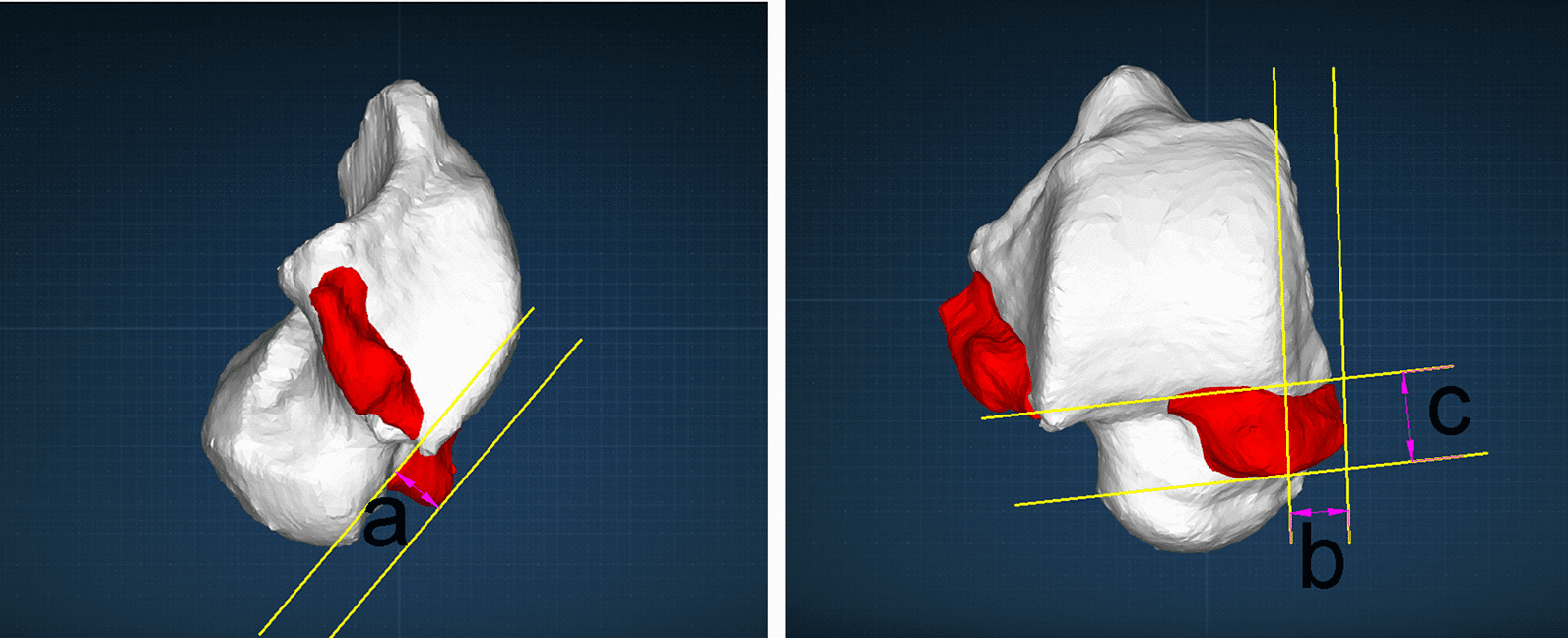 Two three-dimensional reconstructions of a talus with osteophytes in red and measured distances a, b and c between yellow reference lines