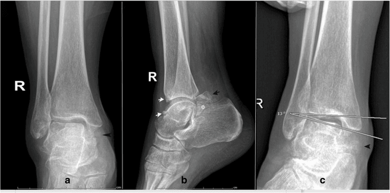 Three radiographs of a right ankle (a to c) with arrows marking anterior tibial and talar osteophytes on the lateral view and arrowheads at the medial side of the joint