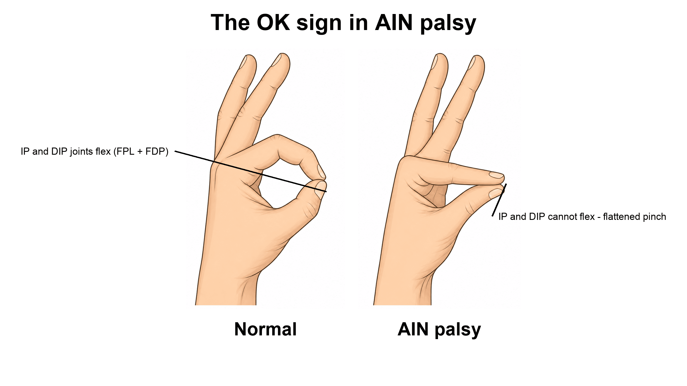 Two hands compared: a normal rounded OK sign versus the flattened teardrop pinch of anterior interosseous nerve palsy where the thumb IP and index DIP joints cannot flex