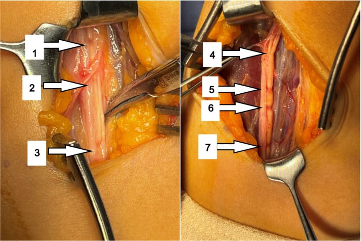 Operative photographs showing multiple hourglass constrictions of anterior interosseous nerve fascicles before and after interfascicular neurolysis.