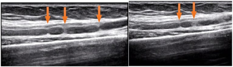 Long-axis ultrasound images showing multiple focal hourglass constrictions of the anterior interosseous nerve.