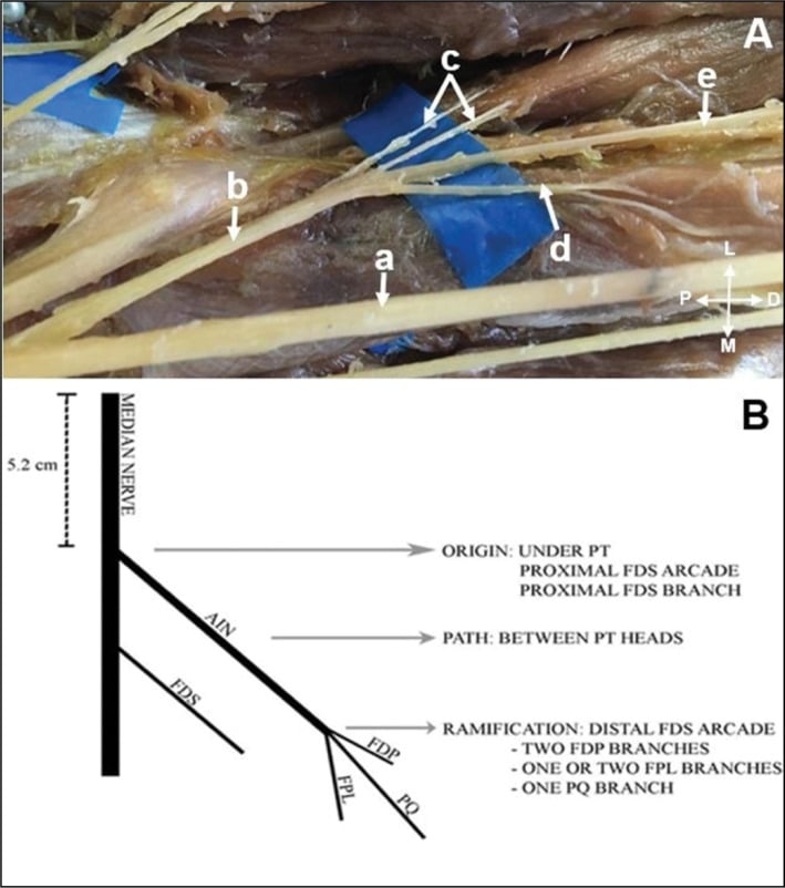 Cadaveric proximal forearm dissection and schematic showing the anterior interosseous nerve origin from the median nerve and its branches to FPL, FDP and pronator quadratus.