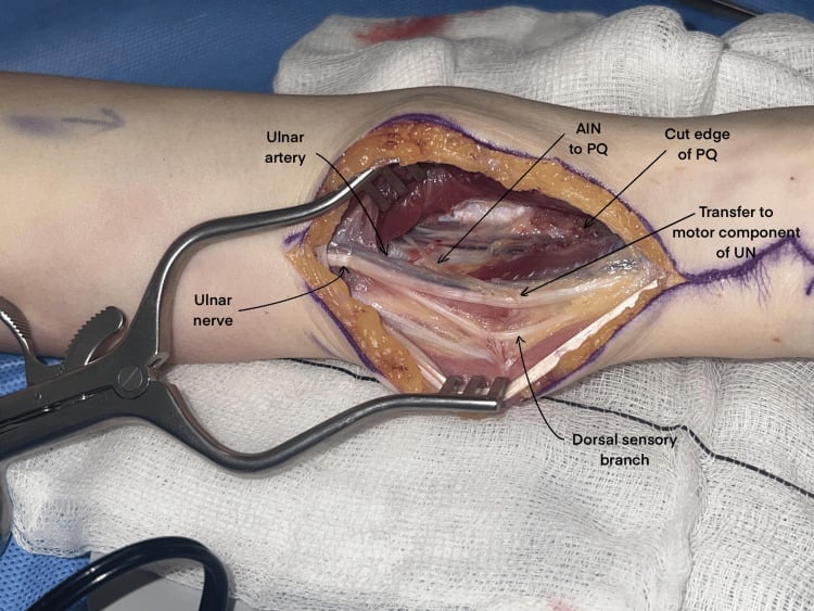 Distal forearm operative field after anterior interosseous nerve transfer to the ulnar motor component, with the ulnar artery and sensory branches labelled.