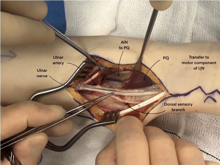 Distal forearm operative exposure labelling the ulnar nerve, ulnar artery, pronator quadratus, anterior interosseous nerve and ulnar motor component.