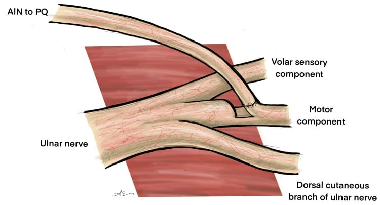 Schematic of the terminal anterior interosseous nerve to pronator quadratus transferred to the ulnar motor component distal to the dorsal cutaneous branch.