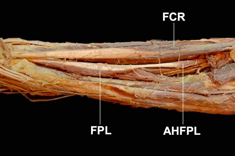 Cadaveric anterior forearm showing the accessory head of flexor pollicis longus between flexor carpi radialis and flexor pollicis longus.