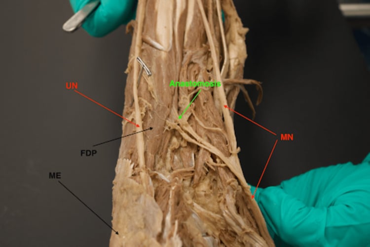 Cadaveric volar forearm showing a type I Martin-Gruber motor anastomosis between the median and ulnar nerves.