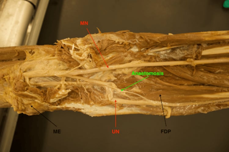 Cadaveric volar forearm showing a type II Martin-Gruber motor anastomosis crossing from the median nerve to the ulnar nerve superficial to FDP.