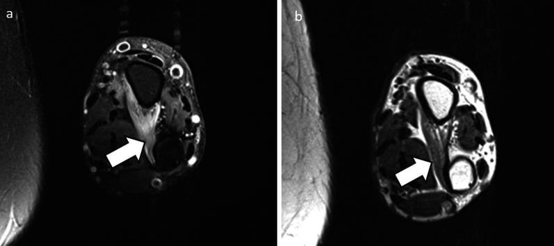 Axial fat-suppressed and T1 MRI showing pronator quadratus denervation oedema and later fatty atrophy in anterior interosseous neuropathy.