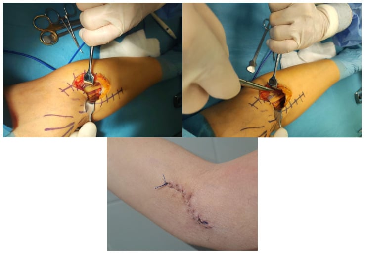Operative sequence showing proximal median nerve decompression through a small volar forearm exposure and the healed incision.