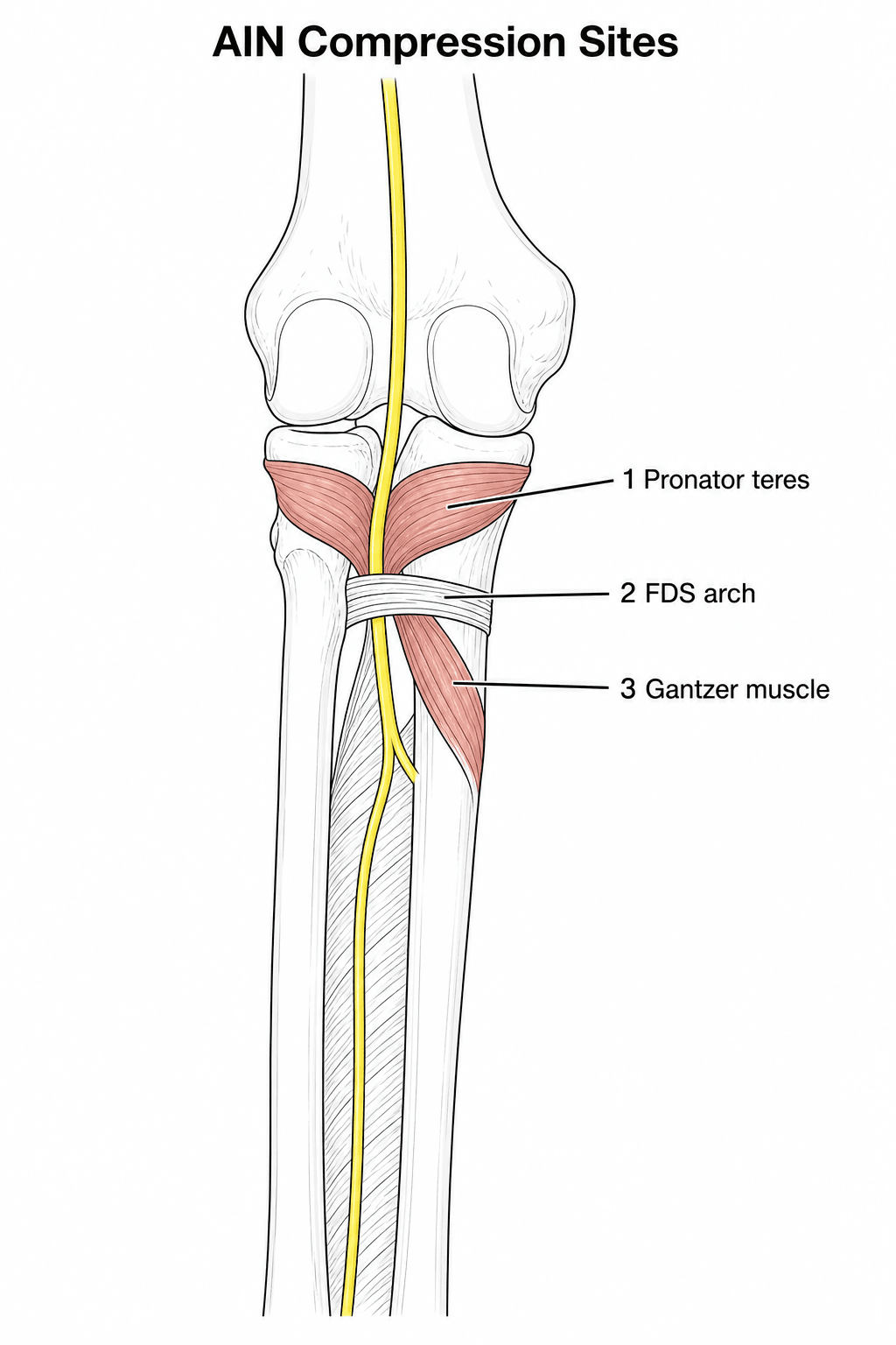 Anterior diagram of the proximal forearm showing the sites where the anterior interosseous nerve can be compressed.