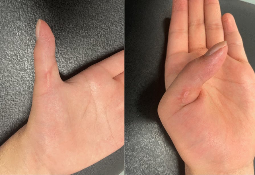 Attempted active thumb movement showing no flexion at the thumb interphalangeal joint