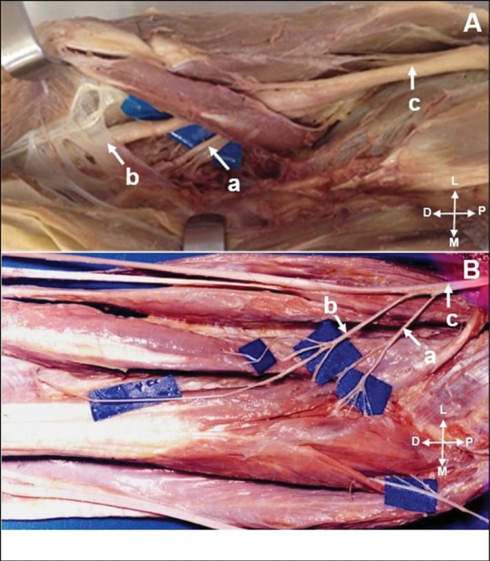 Cadaveric dissection showing anterior interosseous nerve ramification proximal to the flexor digitorum superficialis arcade and a specimen with two separate AIN branches from the median nerve
