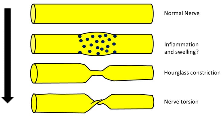 Schematic of a nerve progressing from normal, through inflammatory swelling, to hourglass constriction and finally torsion