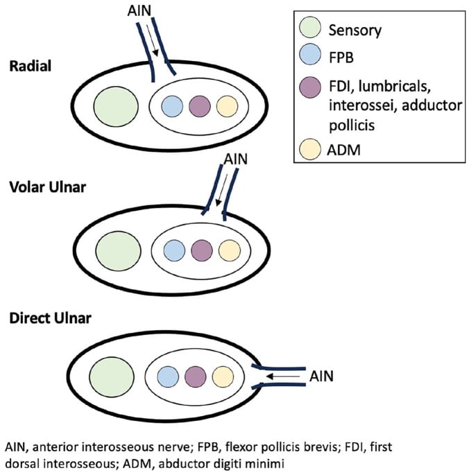 Diagram of anterior interosseous nerve coaptation to the ulnar nerve motor branch through radial, volar ulnar and direct ulnar approaches