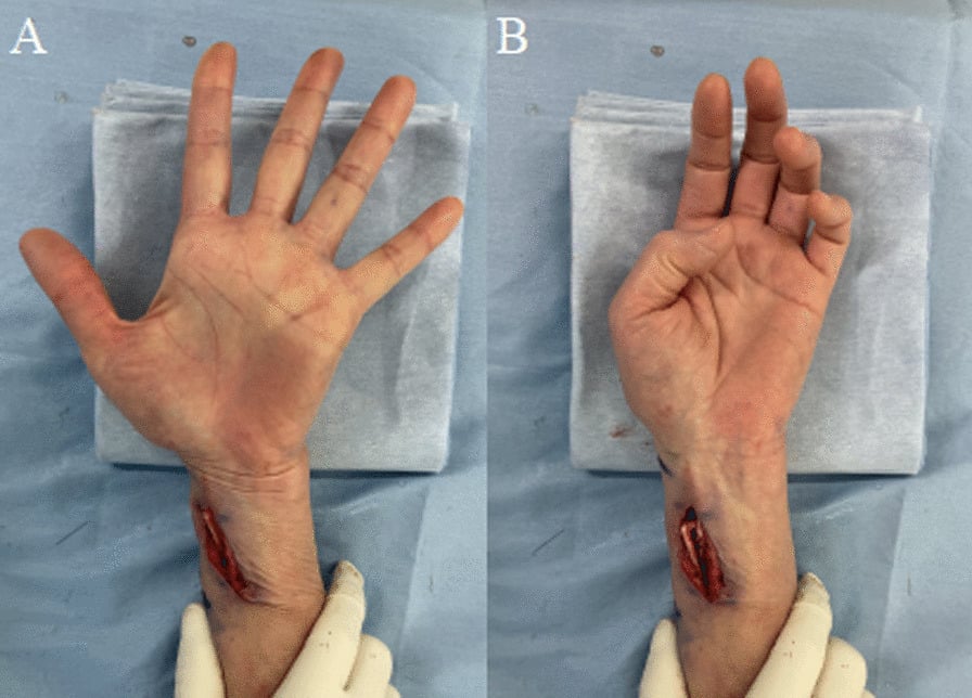 Intraoperative photographs showing smooth active thumb extension and flexion after transfer of extensor carpi radialis longus to flexor pollicis longus