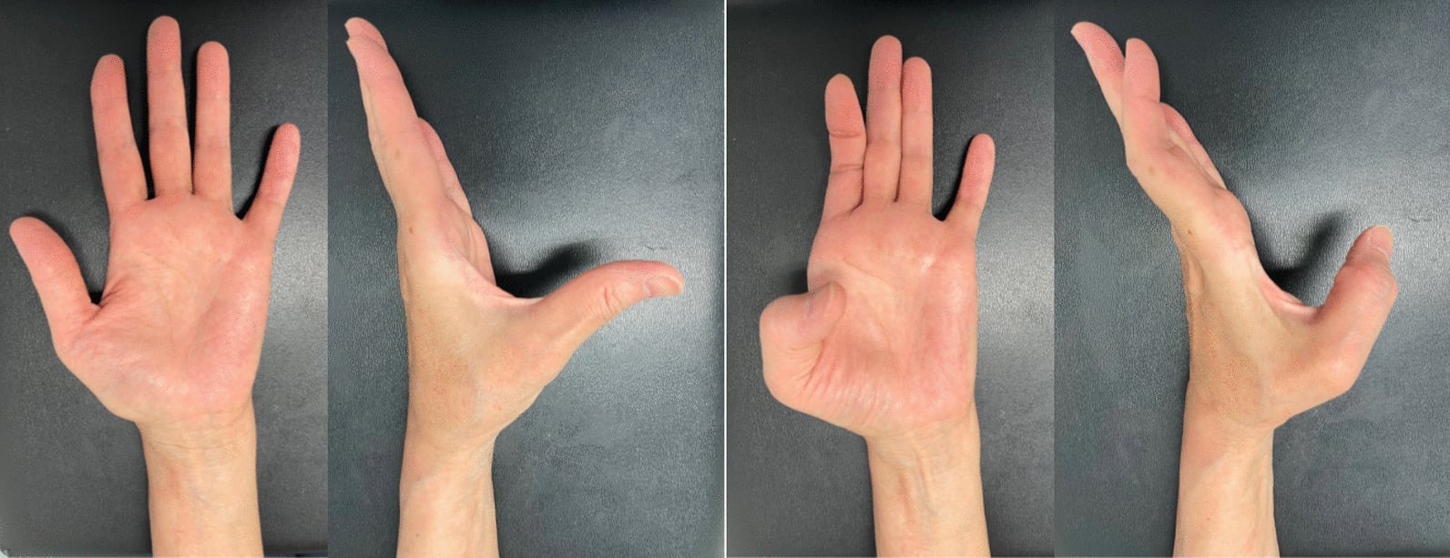 Thumb active range of motion at final follow-up showing full flexion and extension