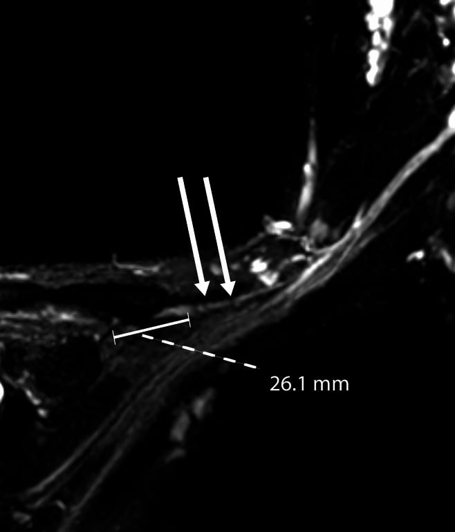 Coronal 3D SPACE MR neurogram showing two focal hourglass constrictions along a peripheral nerve with the distance from a bony landmark measured