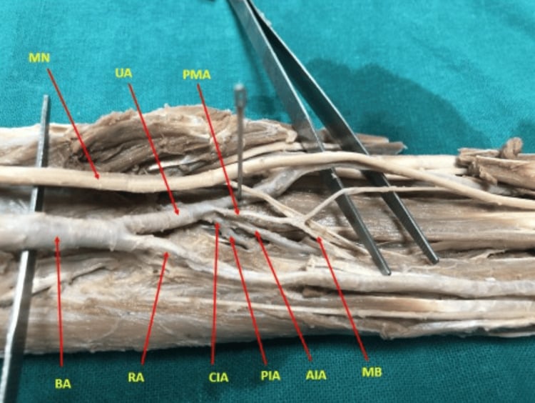 Cadaveric dissection showing a persistent median artery blending with the perineurium of the median nerve in the proximal forearm alongside the anterior interosseous artery