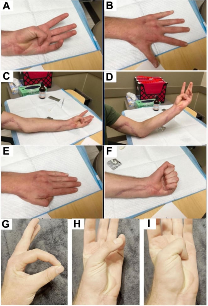 Series of clinical photographs after tendon transfer and nerve repair showing improved hand posture, full finger extension and restored thumb flexion