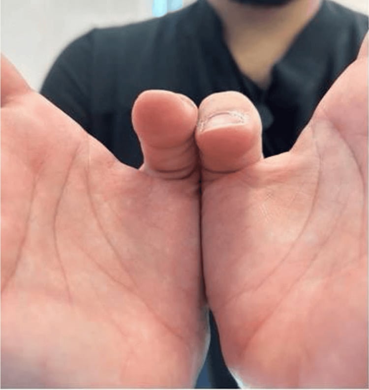 Postoperative photograph showing restored active flexion at the thumb interphalangeal joint seven weeks after surgery