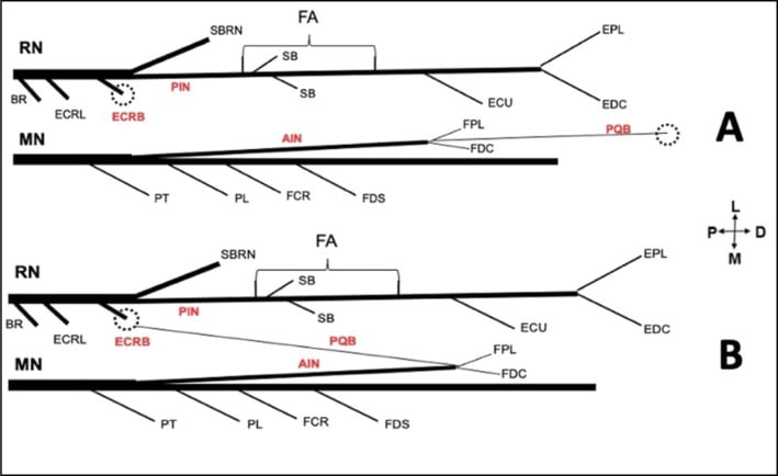 Schematic of transfer of the pronator quadratus branch of the anterior interosseous nerve to the posterior interosseous nerve