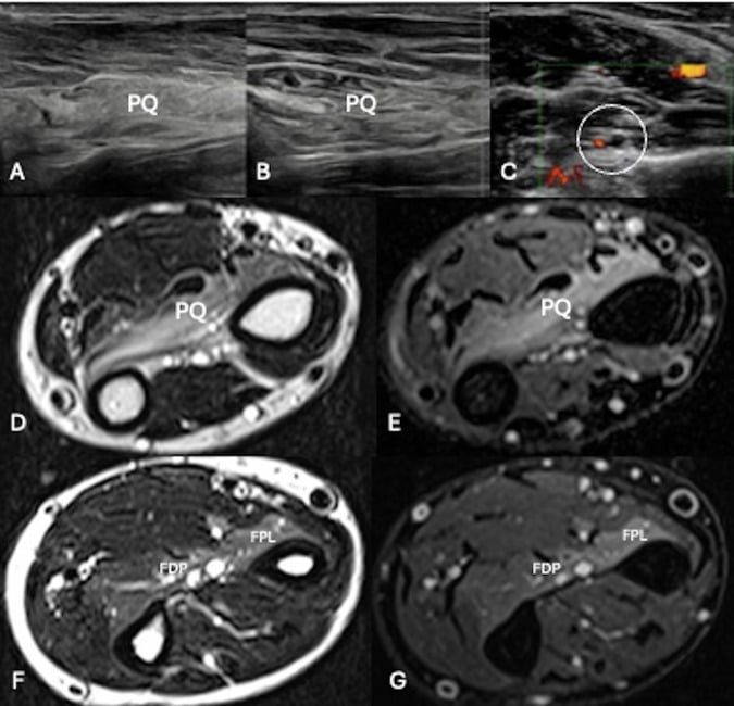 Ultrasound and axial MRI panel showing a thin hyperechoic pronator quadratus, a thickened anterior interosseous nerve and denervation signal change in flexor pollicis longus and flexor digitorum profundus