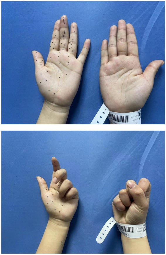 Bilateral hand comparison showing weak thumb and index flexion on the affected side during attempted pinch