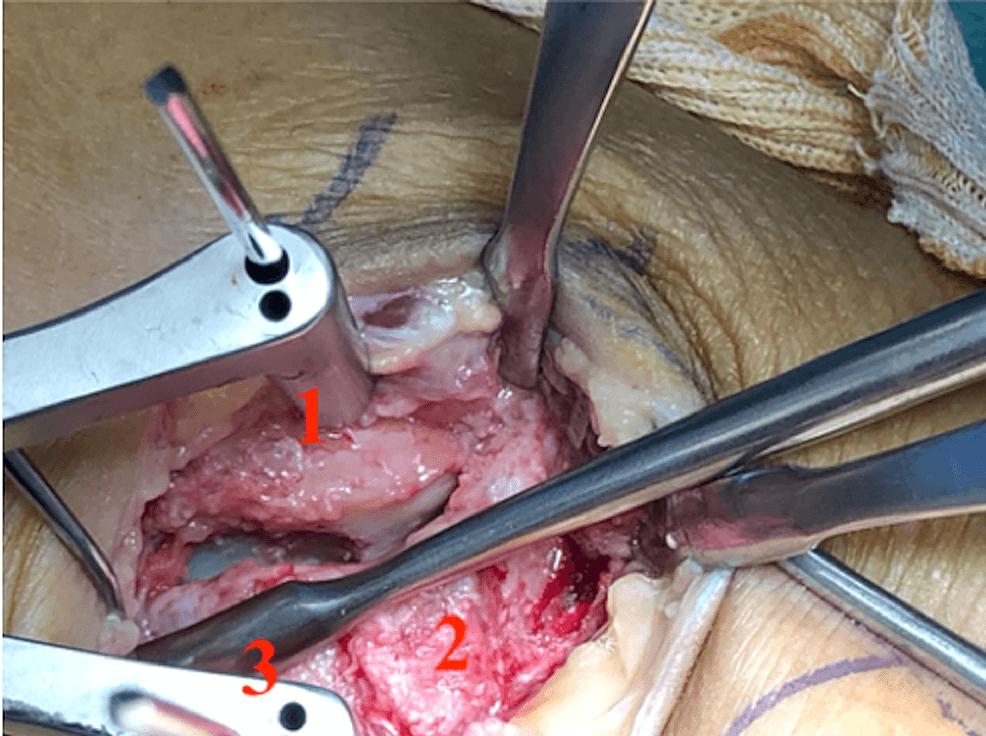 Operative view after reduction of the anterior-process fragment at the calcaneocuboid joint