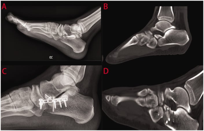 Preoperative oblique foot radiograph and 3D CT reconstruction of anterior process calcaneus fracture