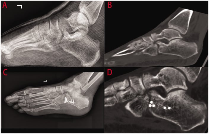 Postoperative foot radiographs demonstrating headless compression screw fixation of anterior process calcaneus fracture