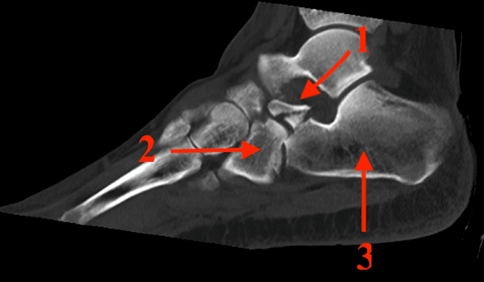 Sagittal CT labelling the anterior process, cuboid and calcaneus in an intra-articular fracture