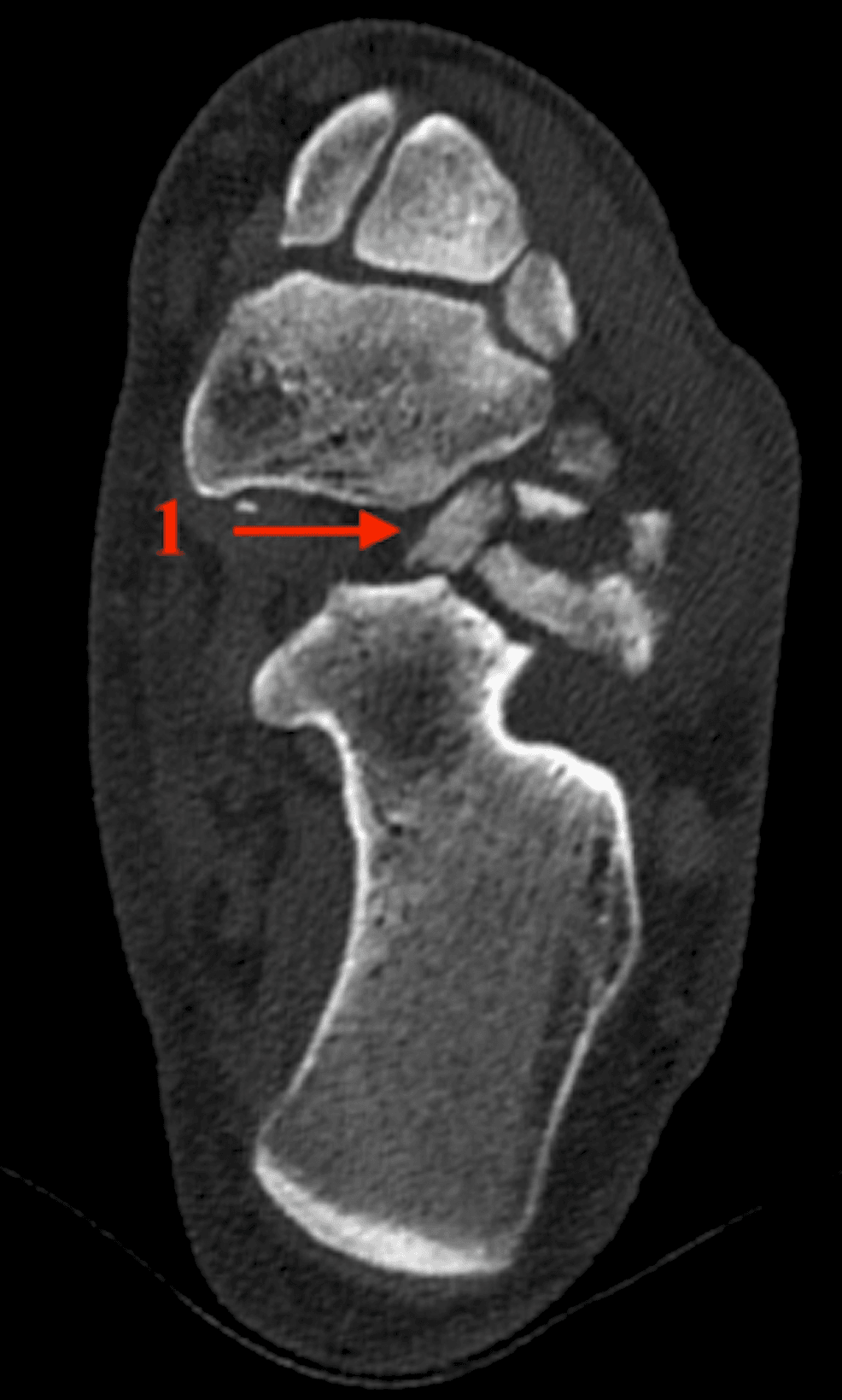 Axial CT showing comminution of the cuboid associated with an anterior-process fracture