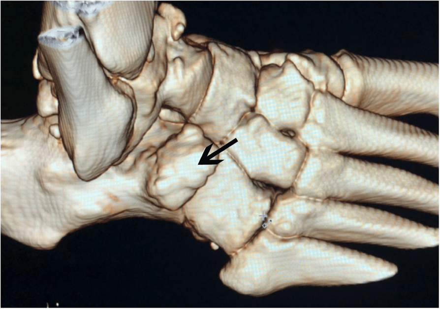 Three-dimensional CT reconstruction showing a large calcaneus secundarius