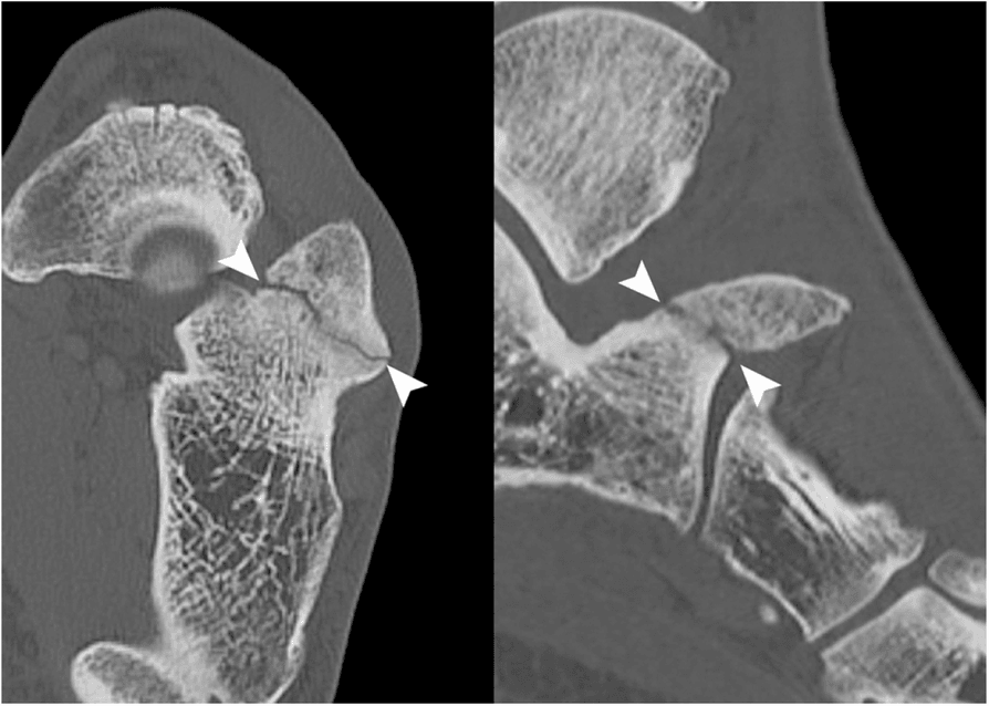 Axial and sagittal CT images showing a corticated calcaneus secundarius synchondrosis