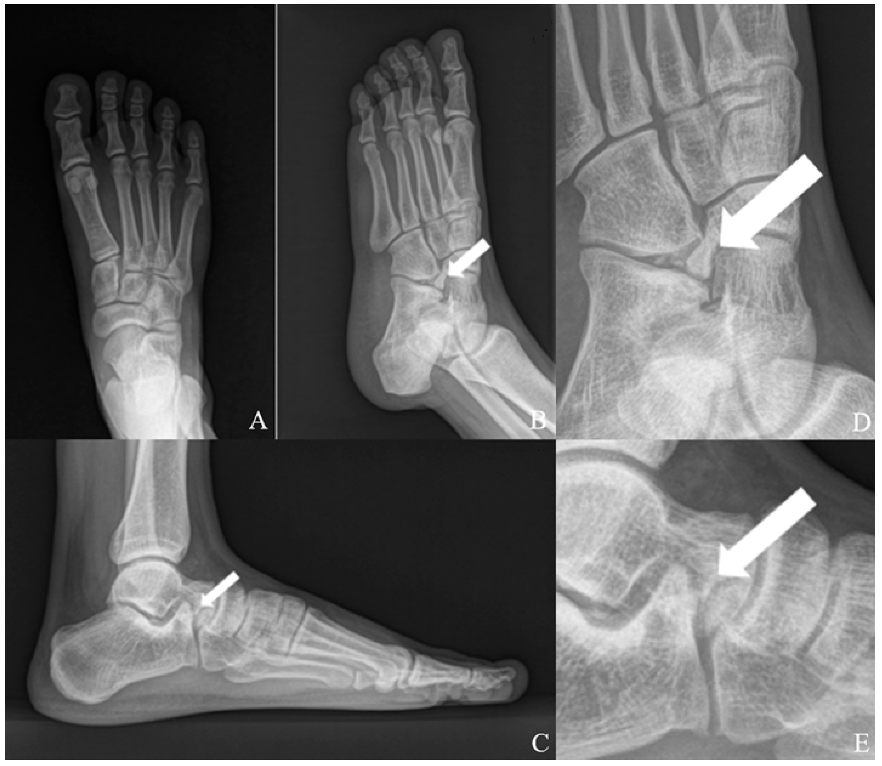 AP, oblique and lateral foot radiographs with enlarged views, arrows marking a well-corticated calcaneus secundarius