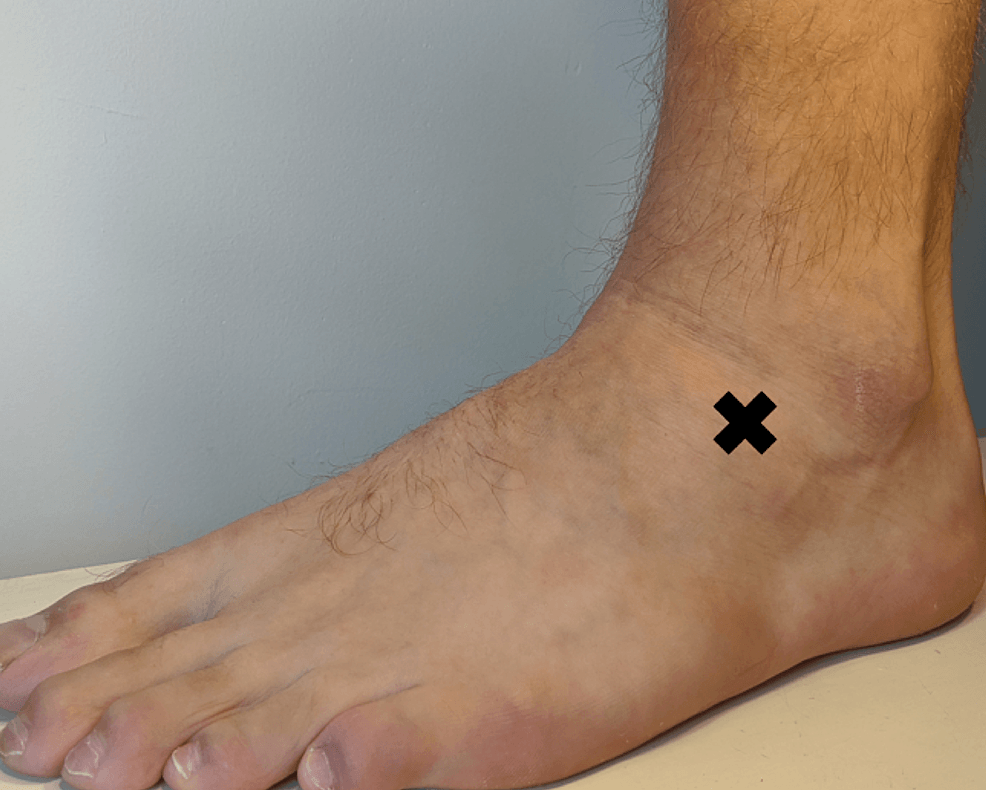 Lateral foot photograph with a cross marking the anterior-process tenderness point distal and anterior to the lateral malleolus