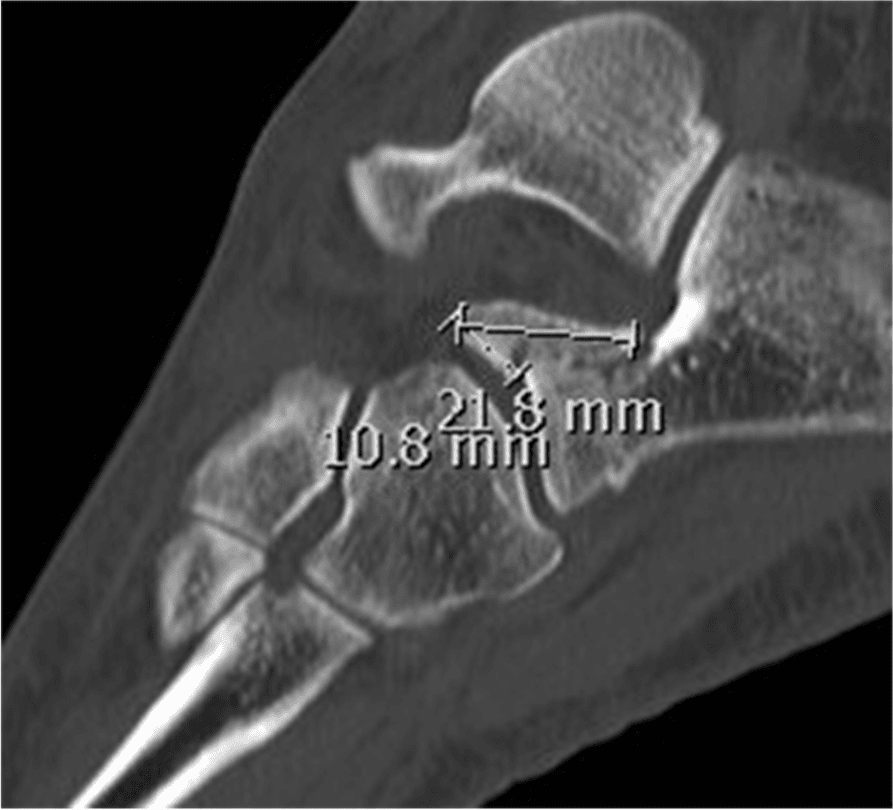 Sagittal CT with callipers measuring anterior-process fragment length and depth