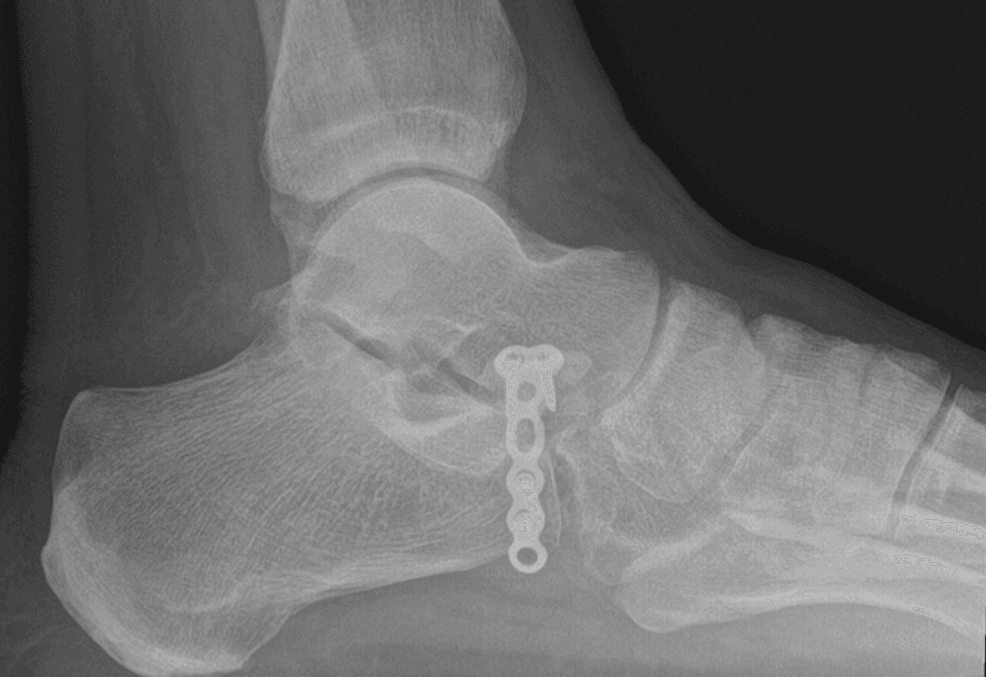 Four-month lateral foot radiograph showing union after anterior-process locking-plate fixation