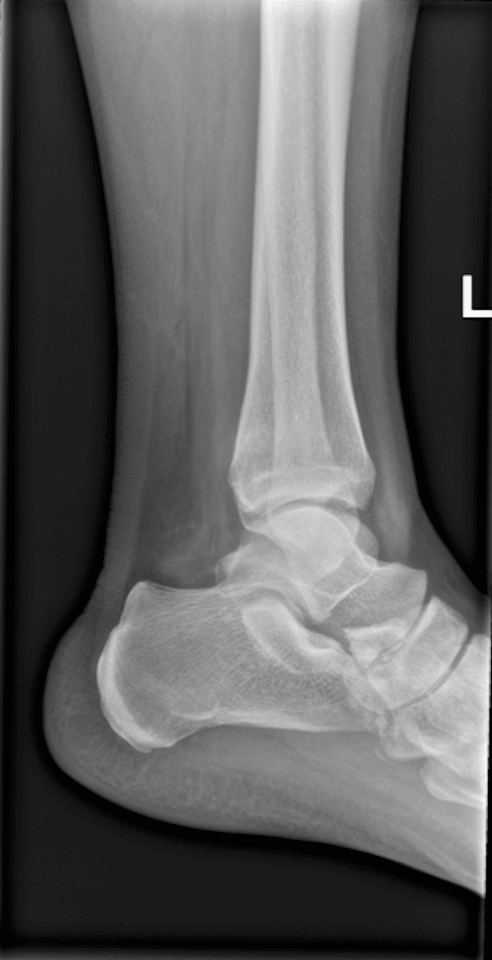 Lateral ankle radiograph, marked L, including an anterior-process calcaneus fracture