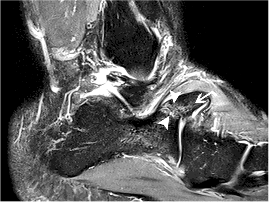 Fat-suppressed sagittal MRI showing oedema at a calcaneus secundarius synchondrosis